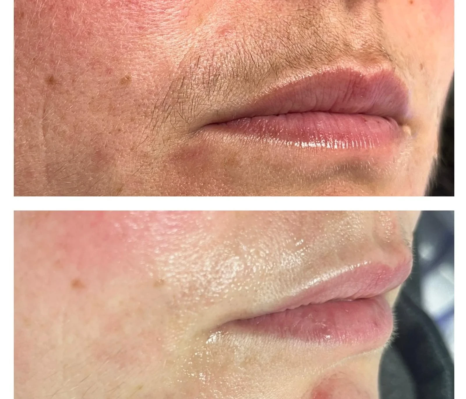 Before and after on upper lip: visible hair above and smoother skin below