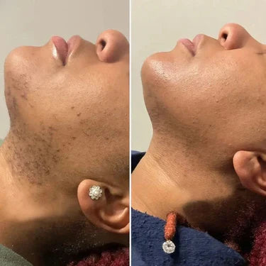 Before and after on neck, side by side